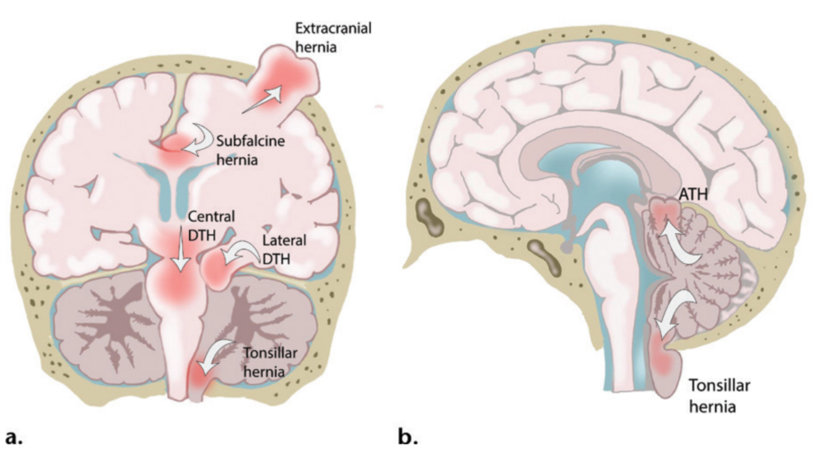 脑疝的类型及其影像学特点_腾讯新闻