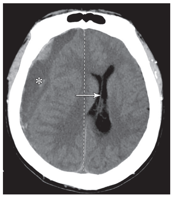 脑疝的类型及其影像学特点_腾讯新闻