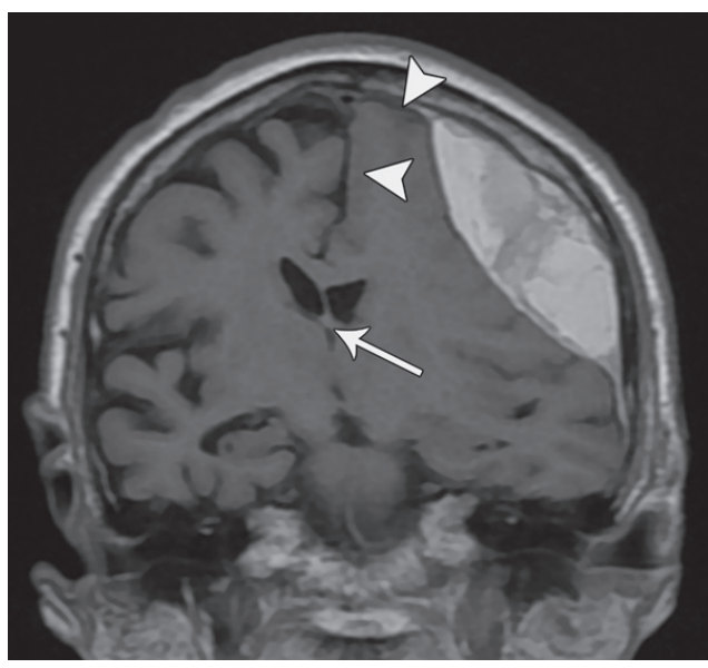 冠状对比增强 ct 图像显示大脑镰自由缘下方的扣带回从左到右突出