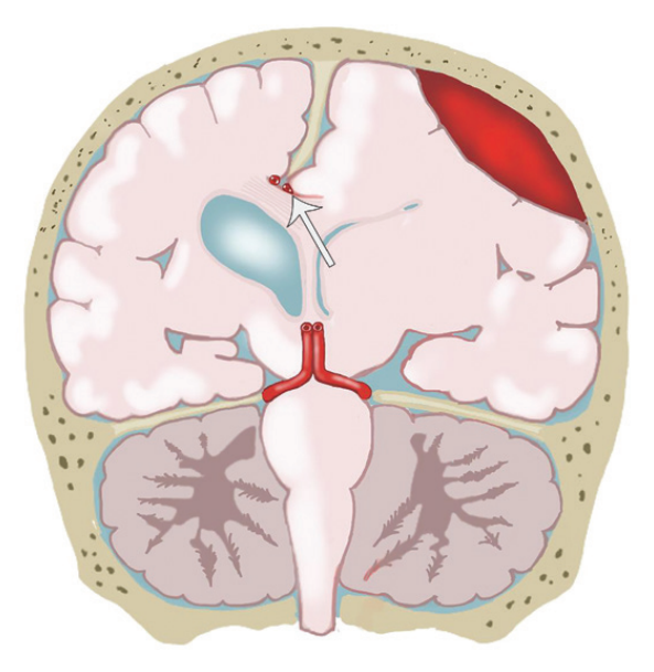 脑疝的类型及其影像学特点