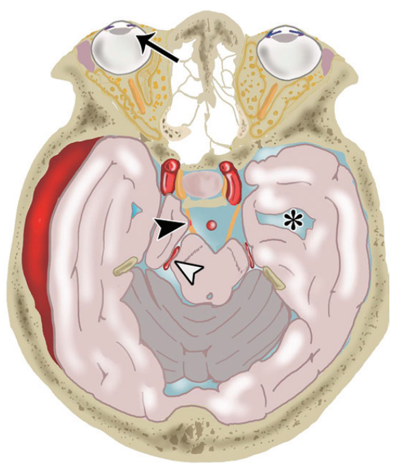 脑疝的类型及其影像学特点