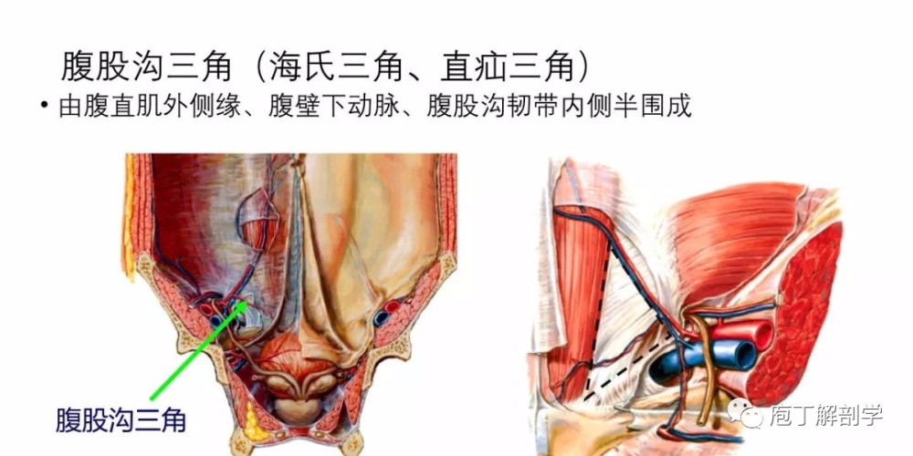 腹股溝三角:又被稱為海氏三角,是指由腹壁下動脈,腹直肌外側緣,腹股溝