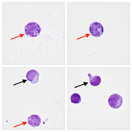 cnsl脑脊液中的嗜碱性粒细胞