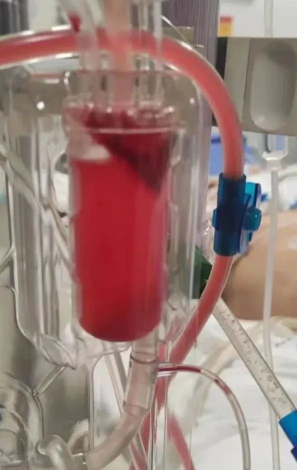 今天的案例最后发现静脉压升高过快,通过盐水冲洗,发现滤器2级凝血