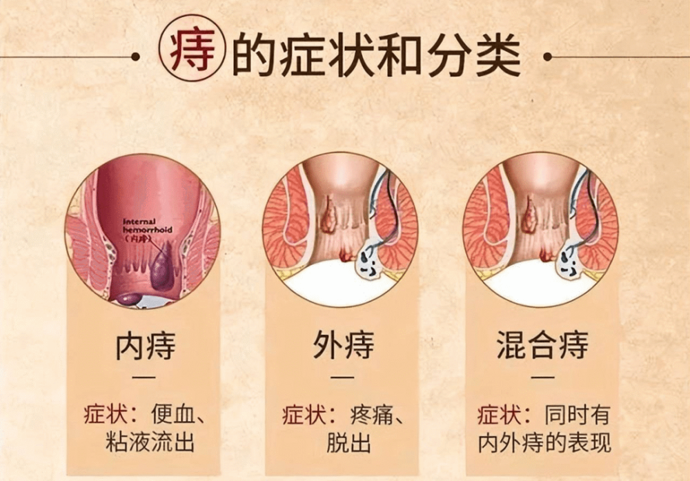 典型症狀是排便出血,外痔是肛門外看得見摸得到的肉球,會有墜脹疼痛感