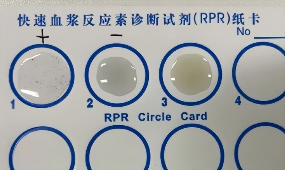 没有性生活,年轻女子却梅毒阳性,医生提醒:5个行为需当心_腾讯新闻