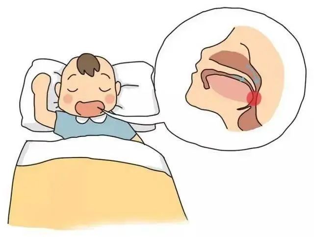 孩子张口呼吸睡觉打鼾当心是腺样体肥大