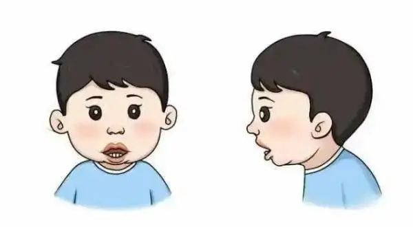 腺样体肥大的危害腺样体肥大为儿童期常见病,表现为鼻咽顶部与咽后壁