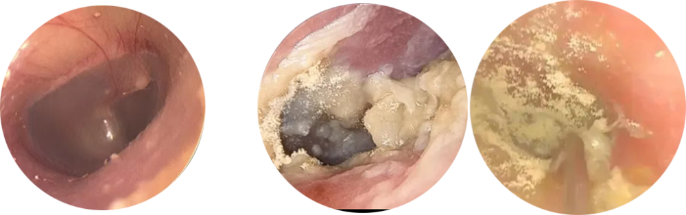 耳朵痒不停,小心真菌性外耳道炎!_腾讯新闻