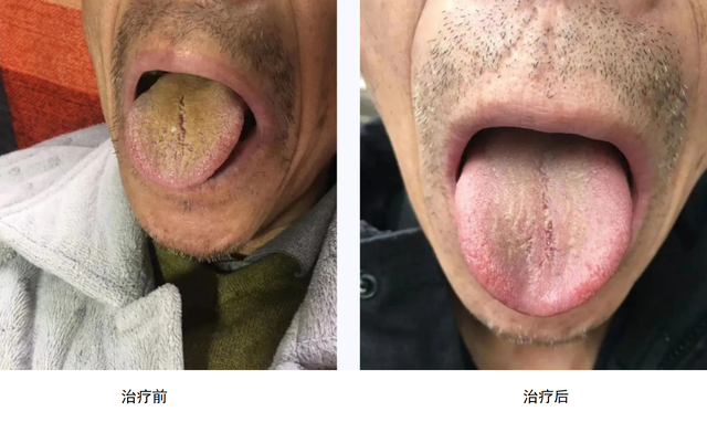 大爷胃癌发作腹痛难忍,中医出手受好评