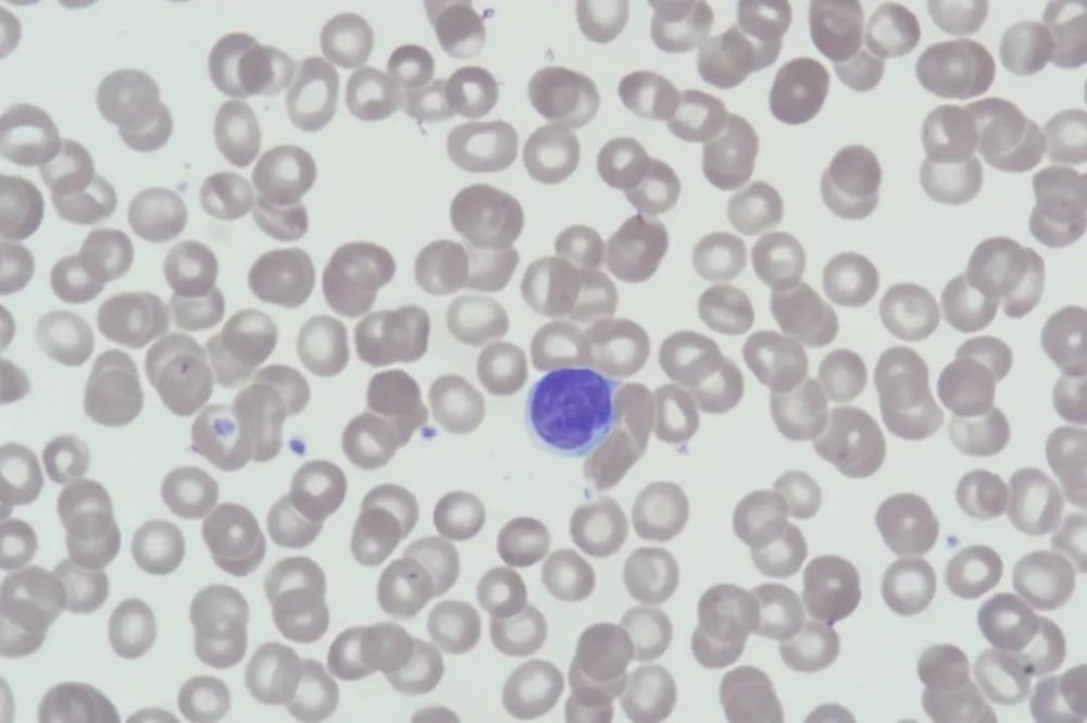 外周血涂片检查时发现的sezary细胞_腾讯新闻