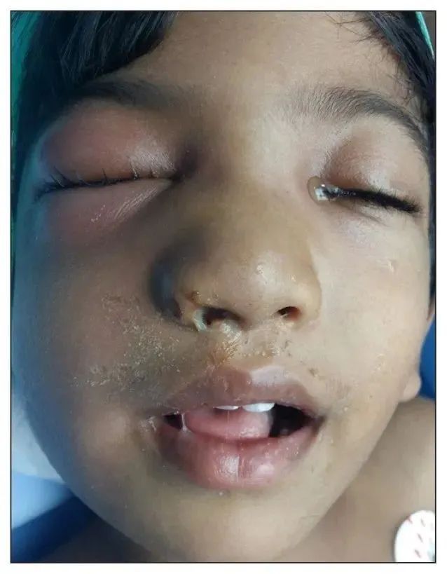 鼻疖病在症状上可轻可重,轻的就是单纯的红肿疼痛,严重的可能导致眼