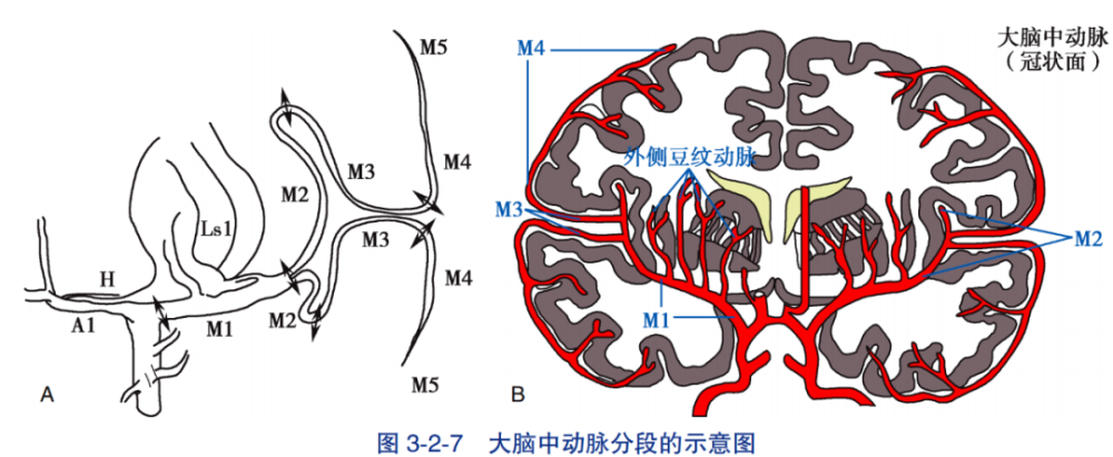 經外側裂-島葉入路基底節區腦出血清除術應用解剖(3)-人衛書摘_騰訊