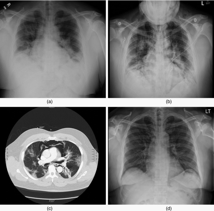 病例分享|c0vid-19患者并发纵隔气肿_腾讯新闻