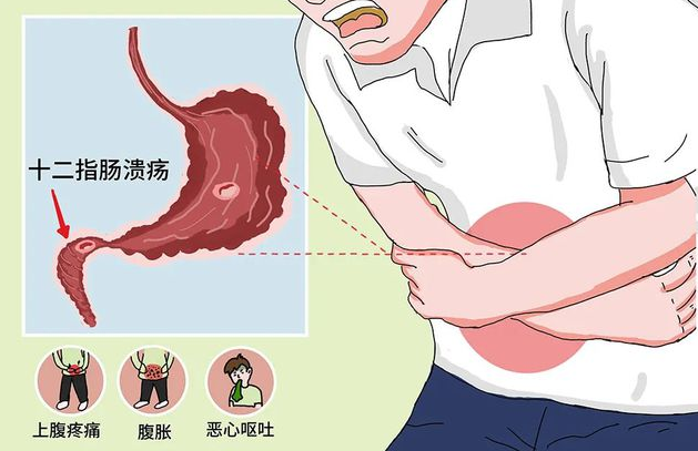 【医心为您】​消化内科：春季消化系统常见病插图6