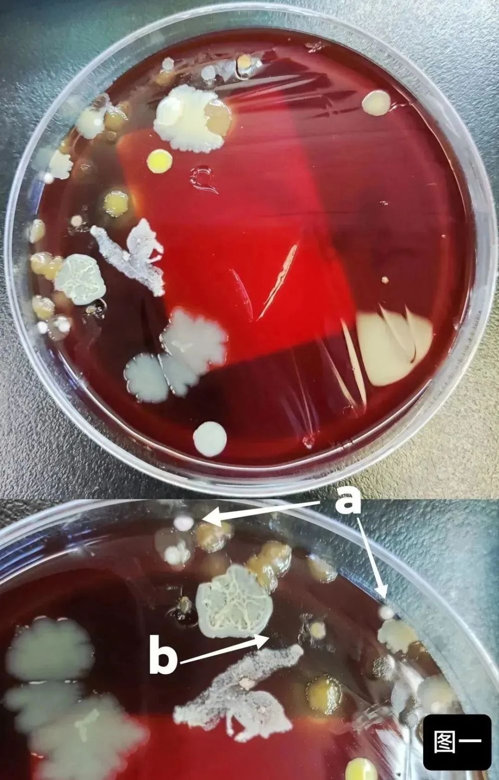 近1年半咳嗽咳痰無力痰中帶血塊送檢微生物學後的延長培養證實了哪些