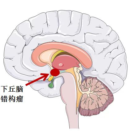 下丘脑错构瘤图片