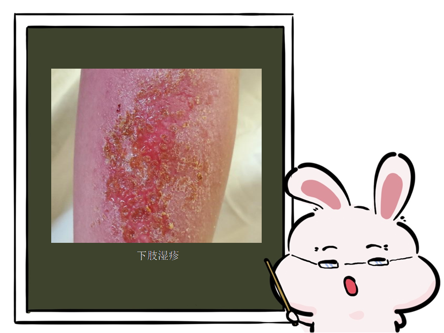 特应性皮炎、湿疹傻傻分不清_腾讯新闻