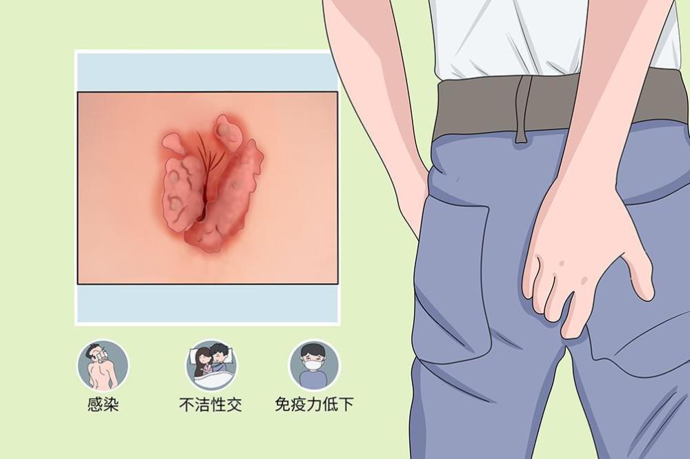 肛门处的"肉疙瘩",不一定是痔疮,也可能是它在捣鬼,别大意_腾讯新闻