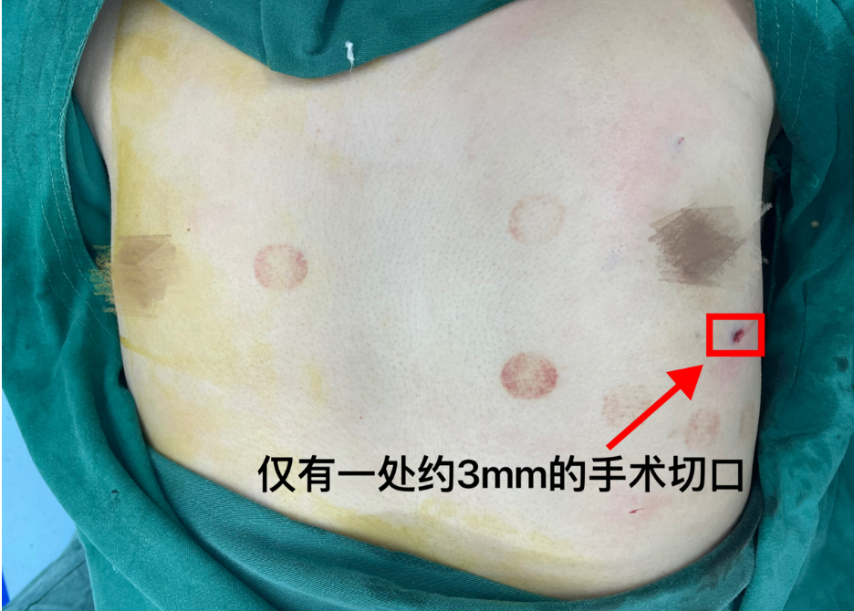 37岁男子乳房异常发育针孔手术为其解决大胸烦恼