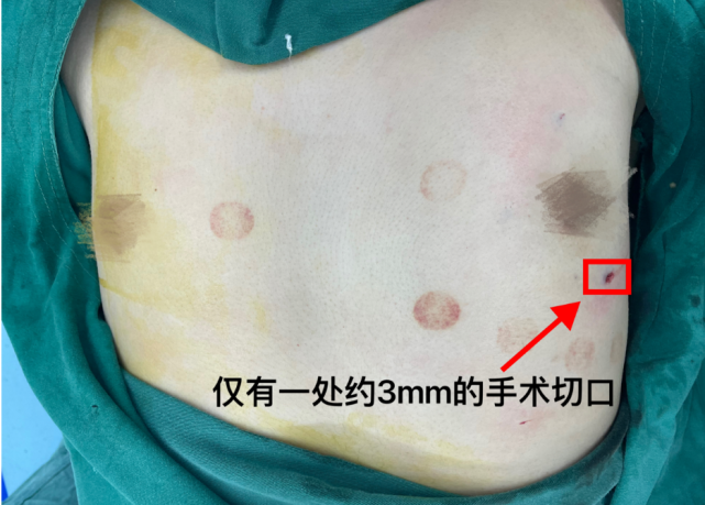37岁男子乳房异常发育,"针孔手术"为其解决"大胸"烦恼!