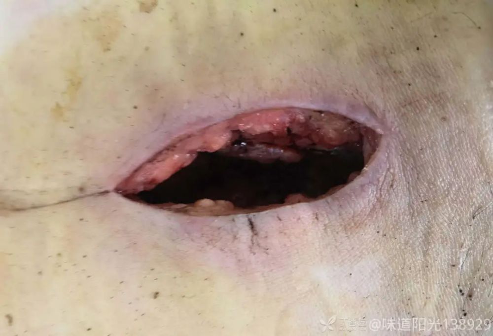 手术后脂肪液化切口愈合不良怎么办