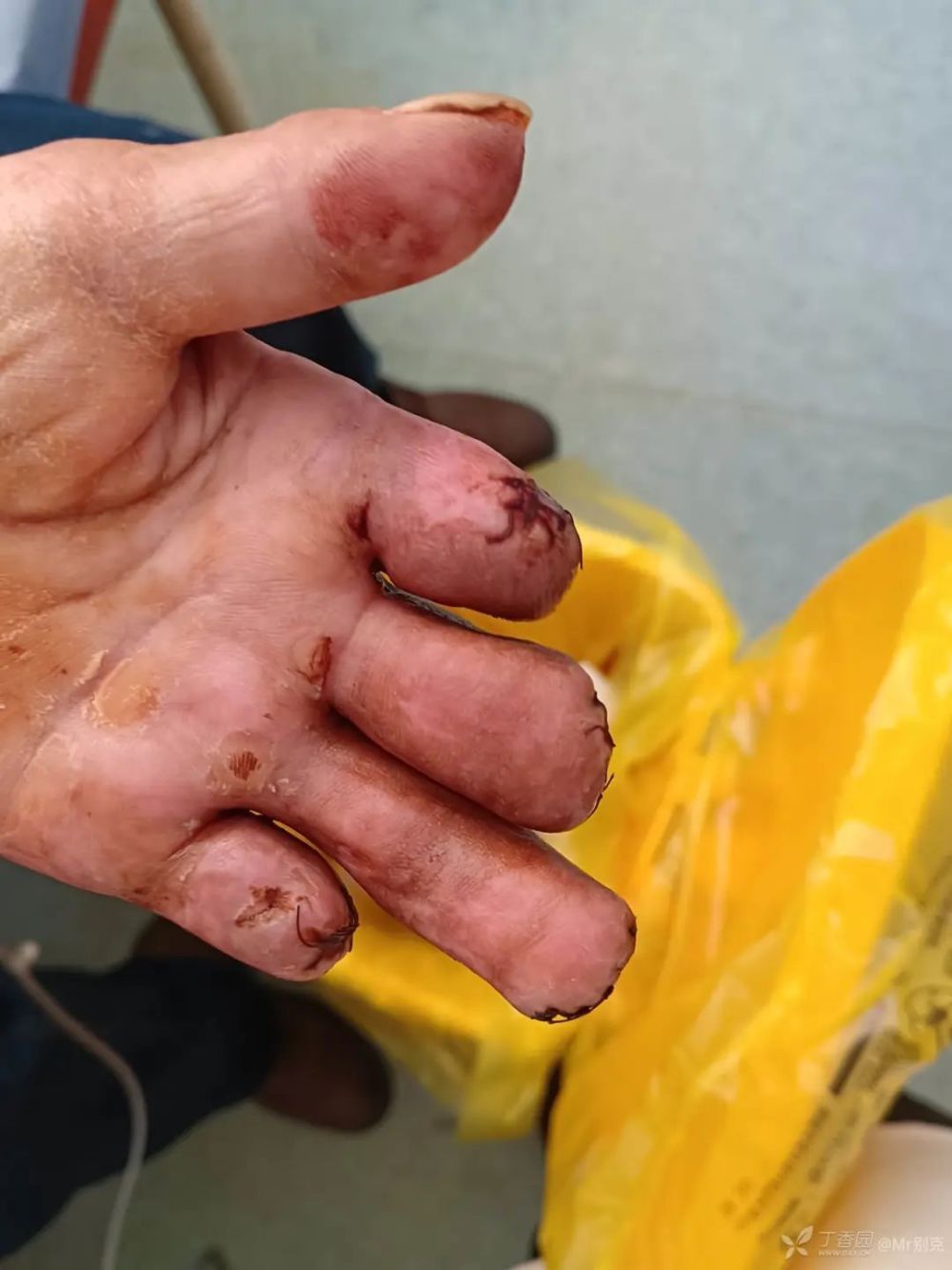 男子4 根手指发黑,一家医院说截指,一家医院要求转院_腾讯新闻