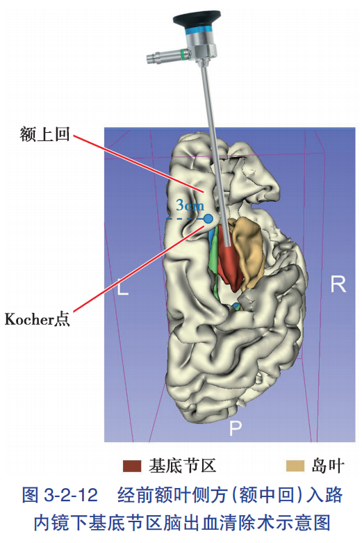 经前额叶侧方(额中回中部)皮质 - 放射冠前部(半卵圆中心前部)- 基底