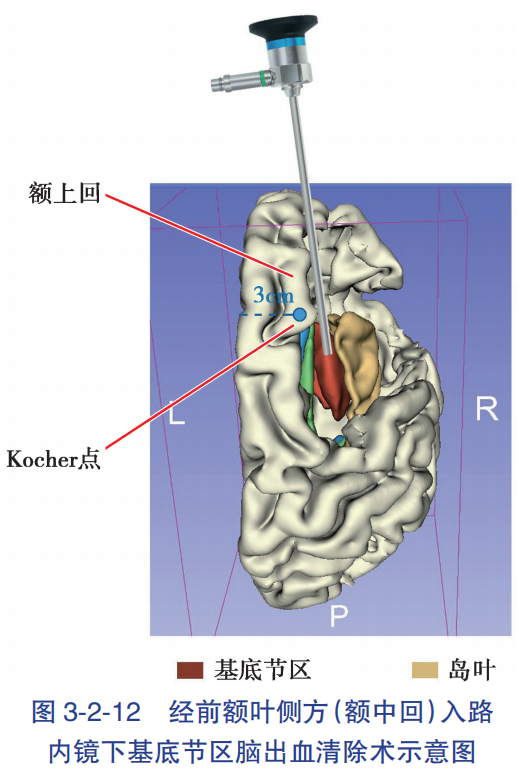 經前額葉側方額中回入路基底節區腦出血清除術應用解剖人衛書摘