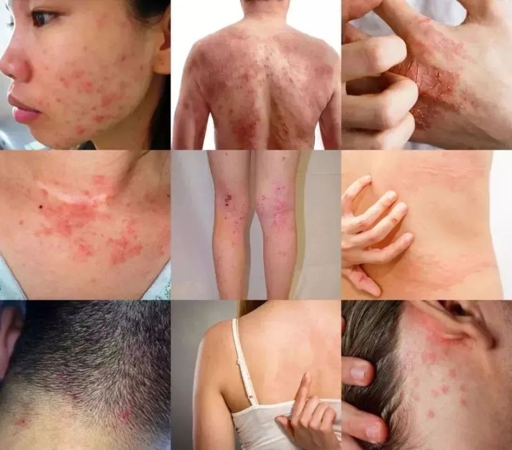湿疹自查:湿疹症状图片!湿疹是什么原因造成的?