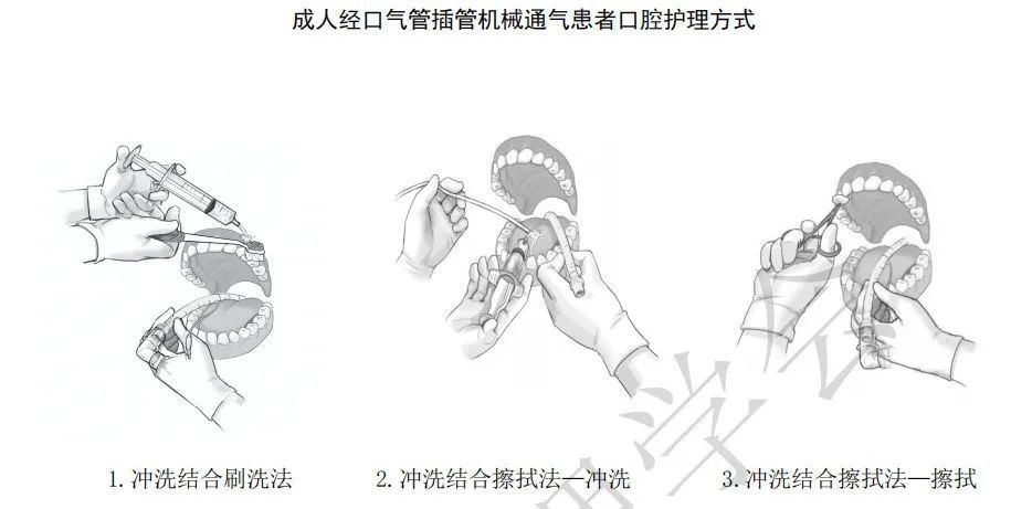 2021年新标准《成人经口气管插管机械通气患者口腔护理》_腾讯新闻