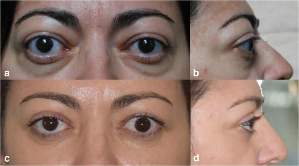 得甲亢后,我做了3次手术,把突出的眼球"按回去"了_腾讯新闻