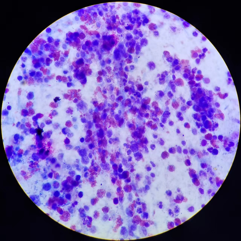 儿童嗜酸粒细胞性支气管炎案例分析_腾讯新闻