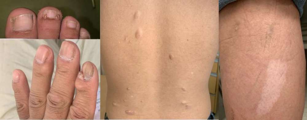 协和医生说|结节性硬化症——隐藏在体检报告单中的罕见病_腾讯新闻