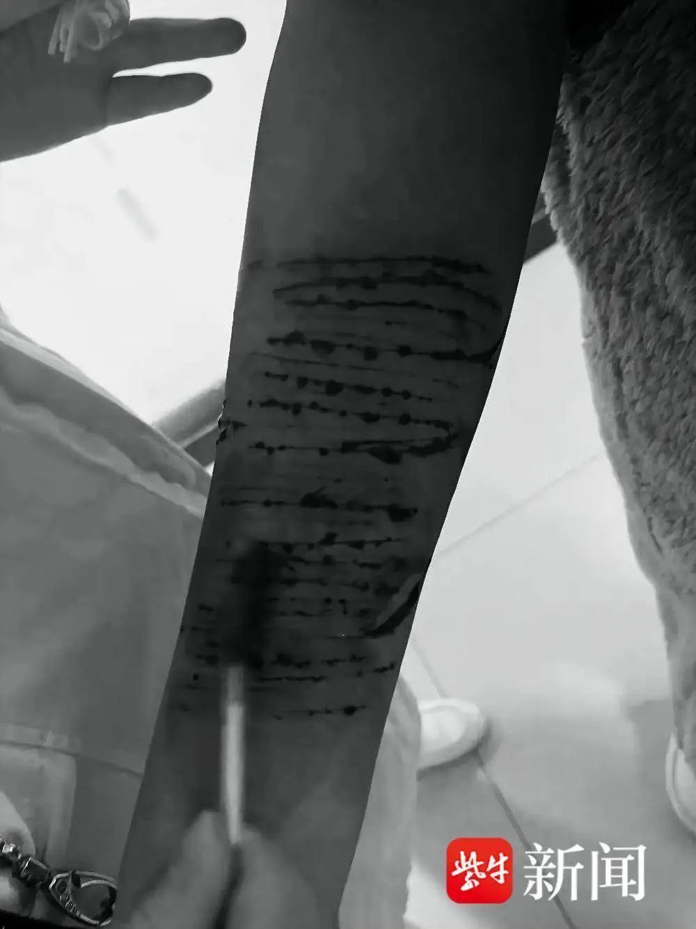 淮安一14岁少女屡屡自残手臂割痕触目惊心