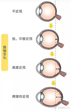 孩子的近视防控是一场马拉松你最好尽早开始