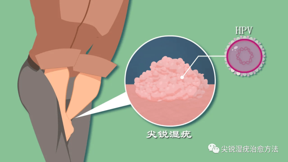 真假性湿锐疣的区别图片