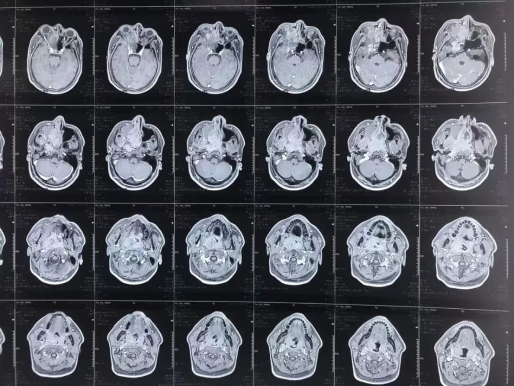 警惕早期鼻咽癌的异常信号_腾讯新闻