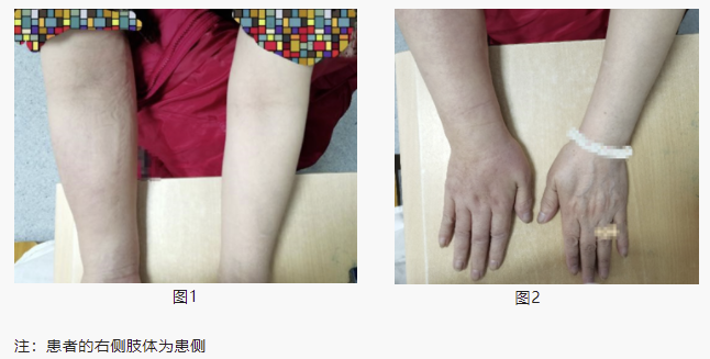 淋巴水肿怎么治