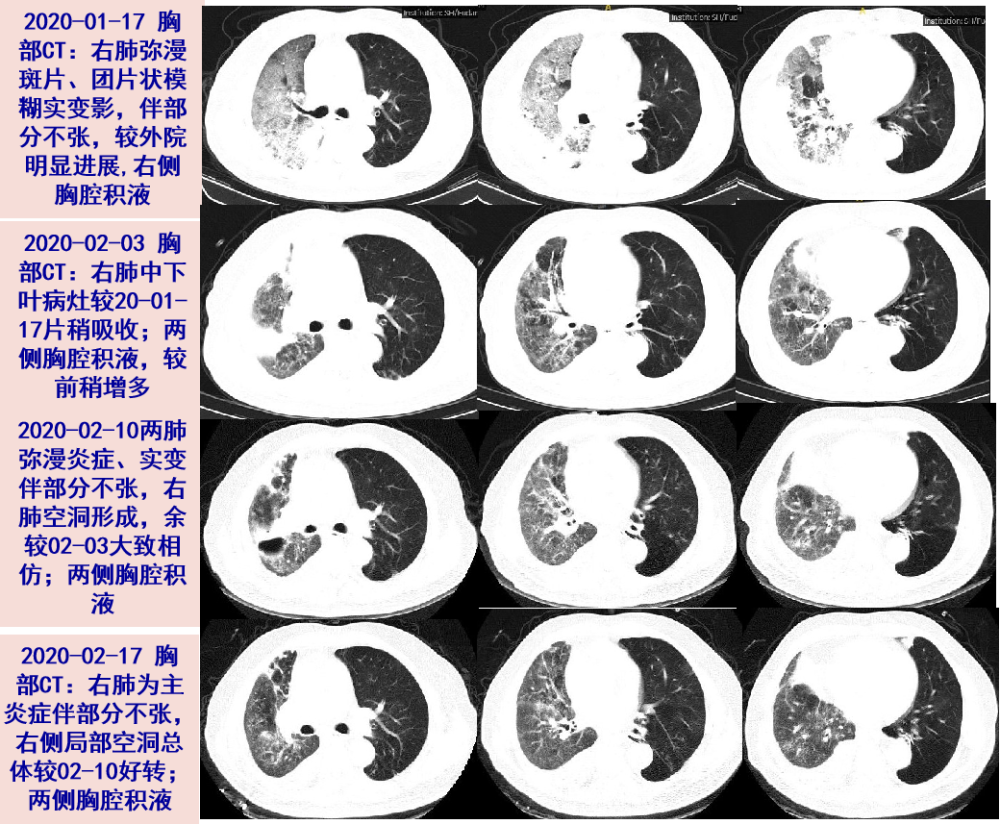 探案丨来势汹汹的重症肺炎罪魁祸首竟是ta
