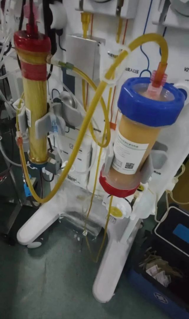 大方县人民医院开展人工肝 血浆置换,成功!_腾讯新闻