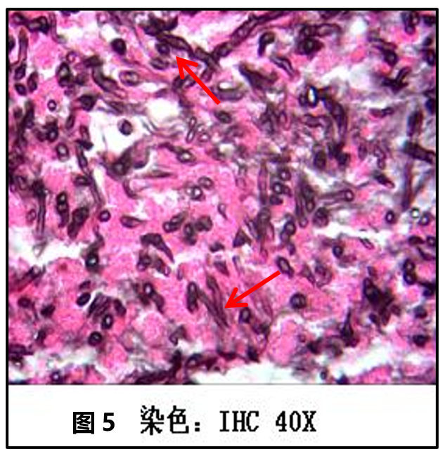 并可见菌团;特殊染色结果:pas,六胺银