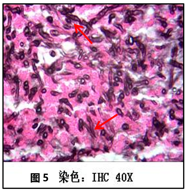 10聲門下氣管上端刷檢纖維素性壞死物內可見真菌菌團(圖5).