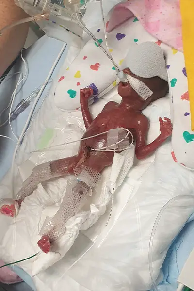 莎琪娜分娩时一整天都在大出血,但她尽力让胎儿在自己体内再多呆一段