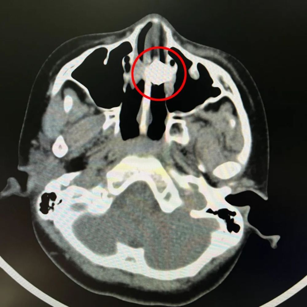 广西一少年将电池塞入鼻腔家长发现时孩子的鼻子已经