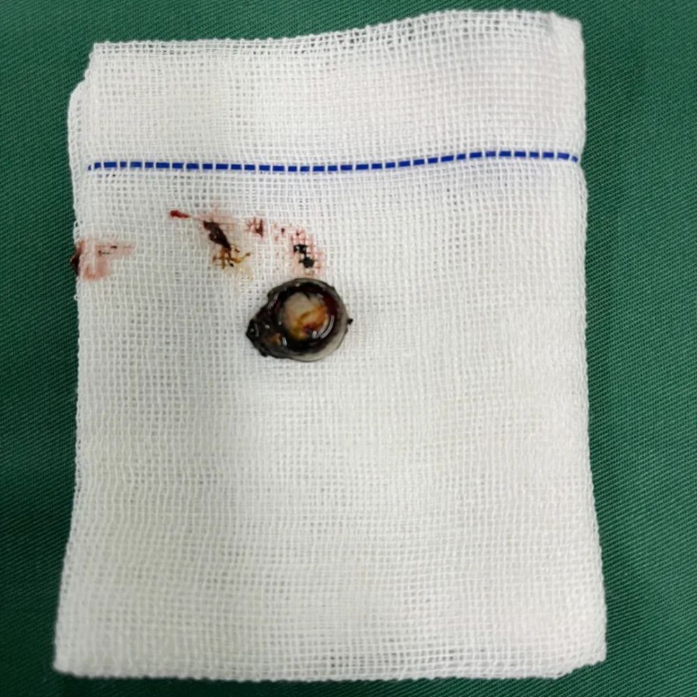 广西一少年将电池塞入鼻腔家长发现时孩子的鼻子已经