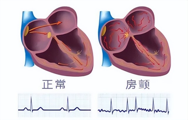 房颤明明是心脏问题,怎么会和血栓扯上关系?医生解答