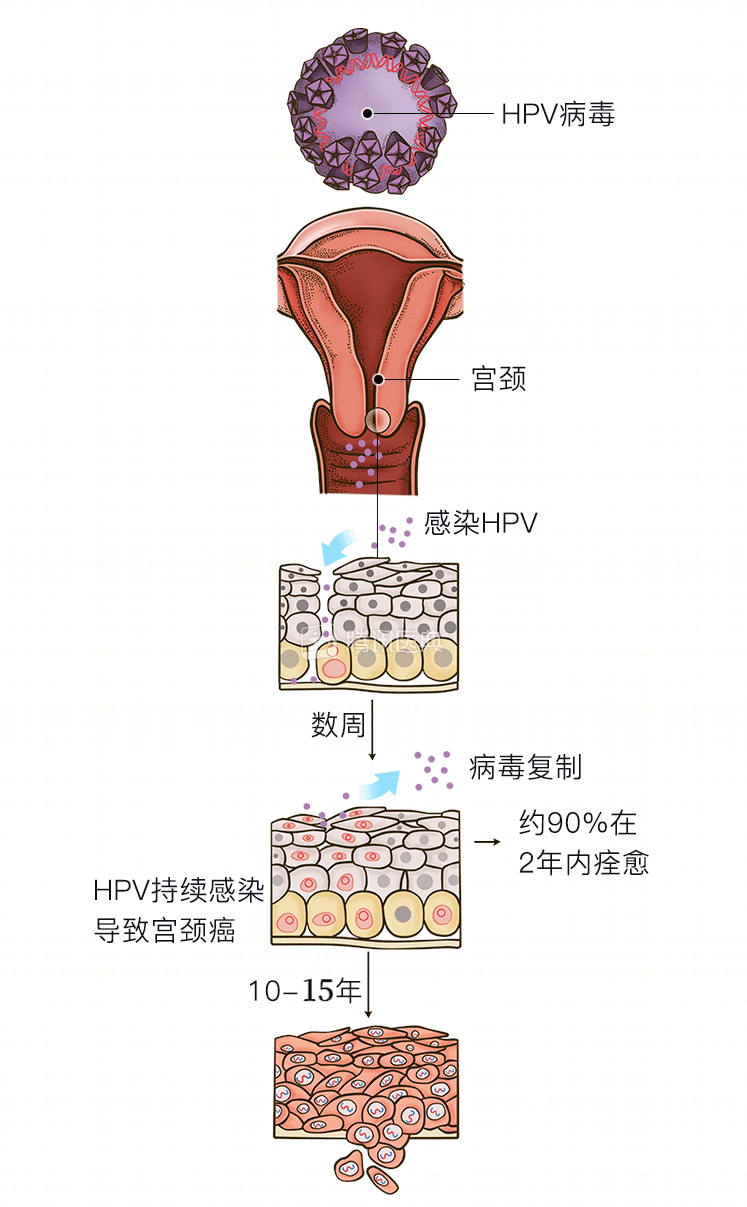 13岁女孩患宫颈癌7年这个危险因素被很多人忽视