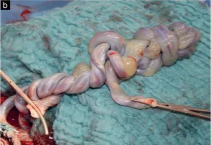 38 周胎儿因脐带胎死宫内,不是绕颈,而是……_腾讯新闻