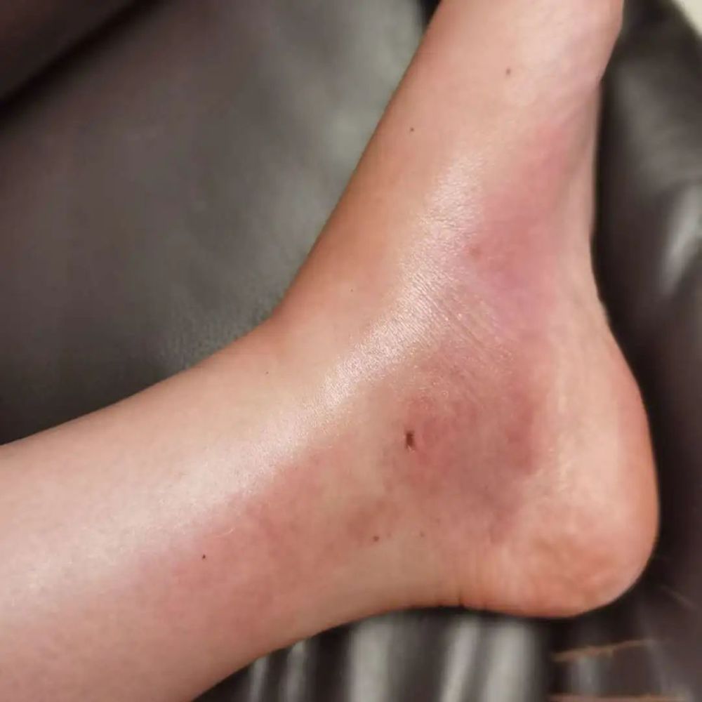 左滑查看伤口情况被叮的脚踝 | 作者供图小提示蜂尾针可释放毒液,人被